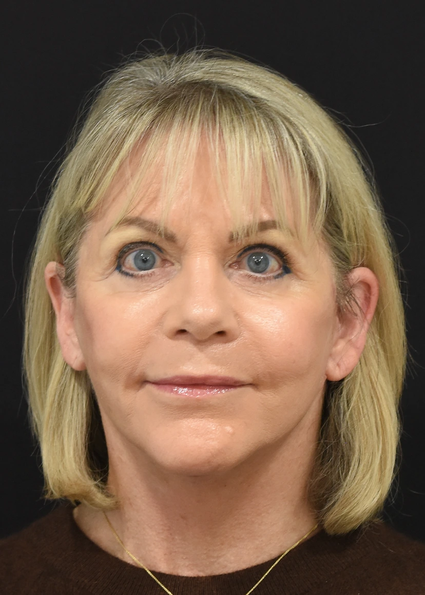 Deep Plane Facelift Patient 30 Set 1 After