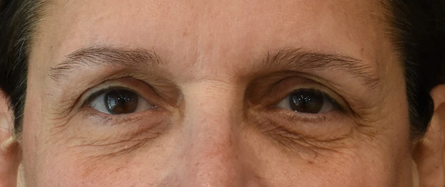 Brow Lift Patient 10 Set 1 Before
